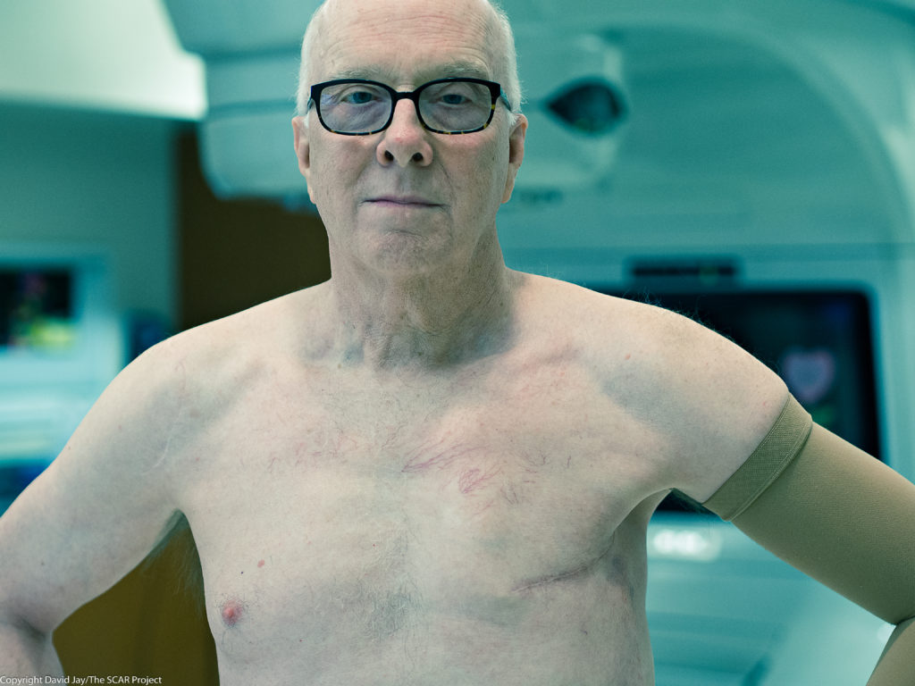 Image of male breast cancer survivor