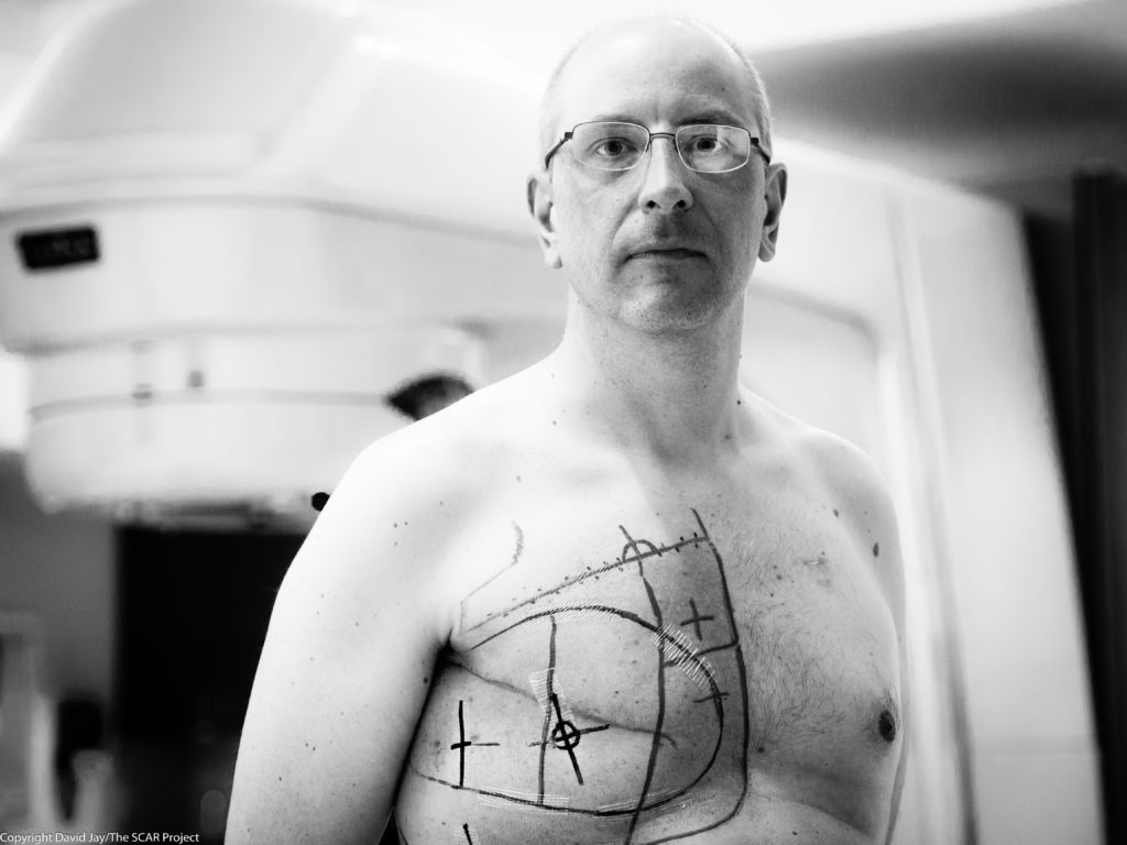 Image of male breast cancer survivor