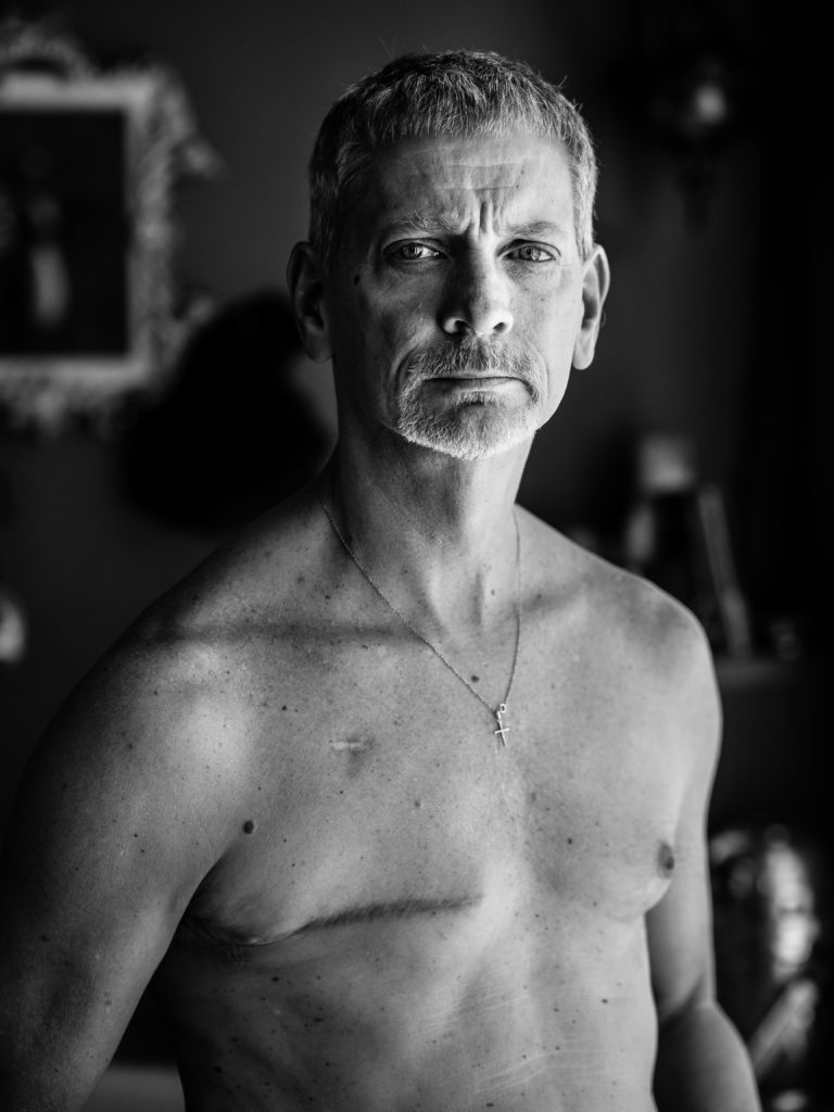 Image of male breast cancer survivor