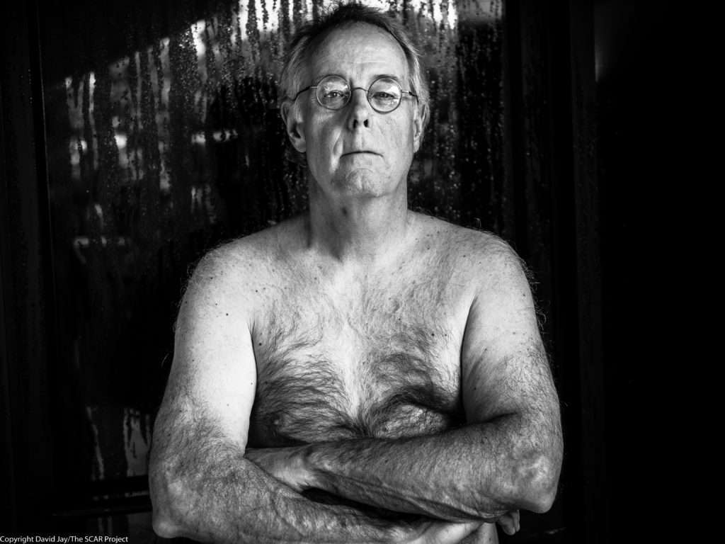 Image of male breast cancer survivor