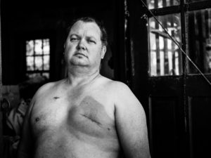 Image of man who had mastectomy